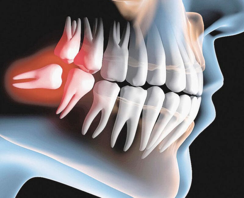 Retirada do dente do siso