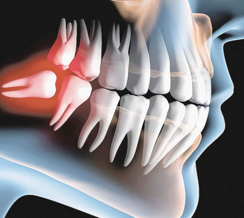 Retirada do dente do siso