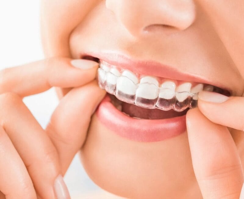 Invisalign - Alinhadores transparentes