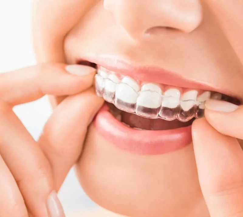 Invisalign - Alinhadores transparentes