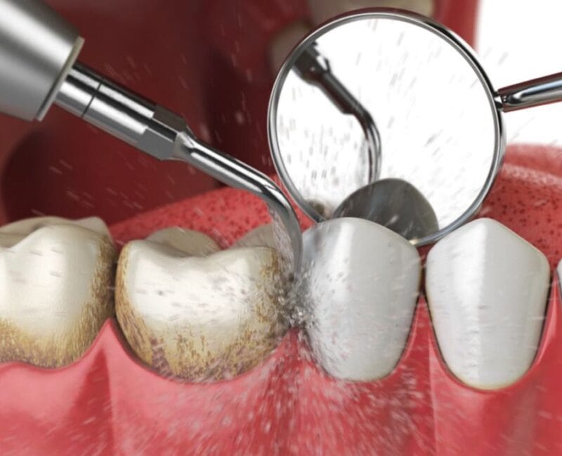 Limpeza profissional Profilaxia Remoção de tártaro