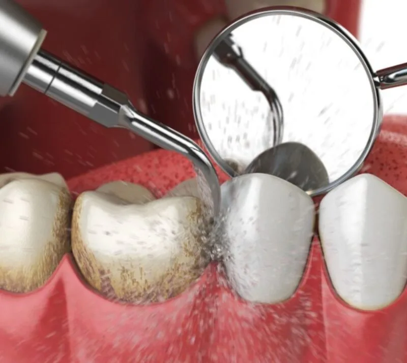 Limpeza profissional Profilaxia Remoção de tártaro