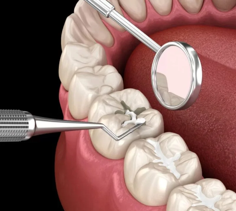 Restauração Dental Curitiba