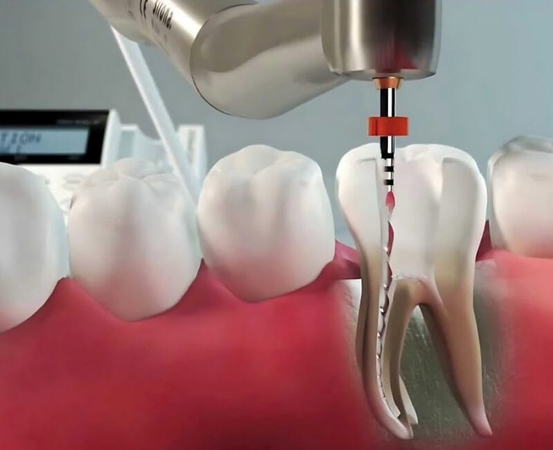tratamento de canal rua padre anchieta bigorrilho curitba-1034x732