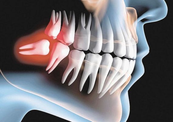 Cirurgia de Retirada do dente do siso Retirada do dente do siso