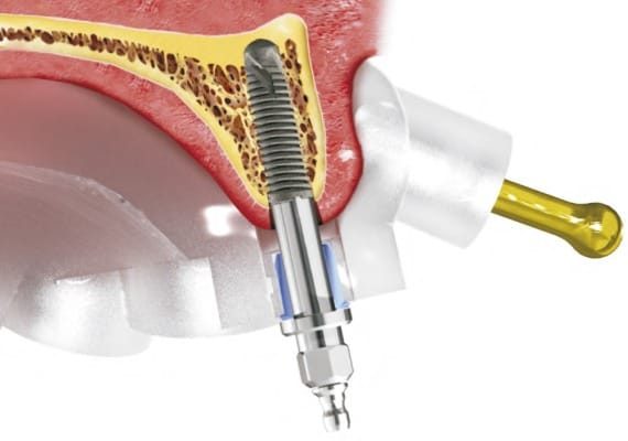 Cirurgia Guiada para Implantes Cirurgia Guiada para Implantes